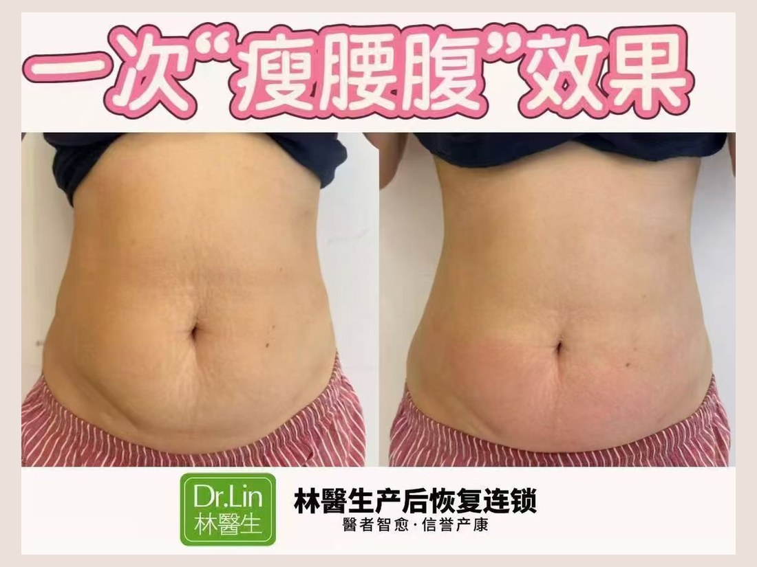 身材管理科部客户案例：一次瘦腰腹效果