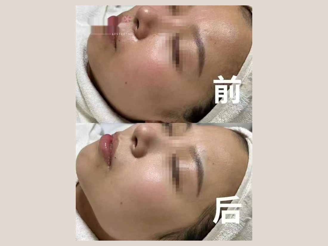 科技美肤部客户案例：面部状态对比
