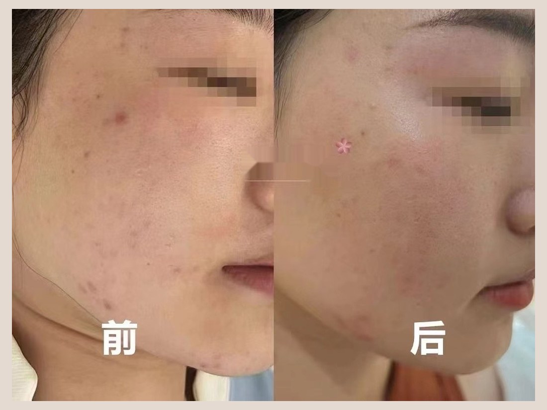 科技美肤部客户案例：面部状态对比