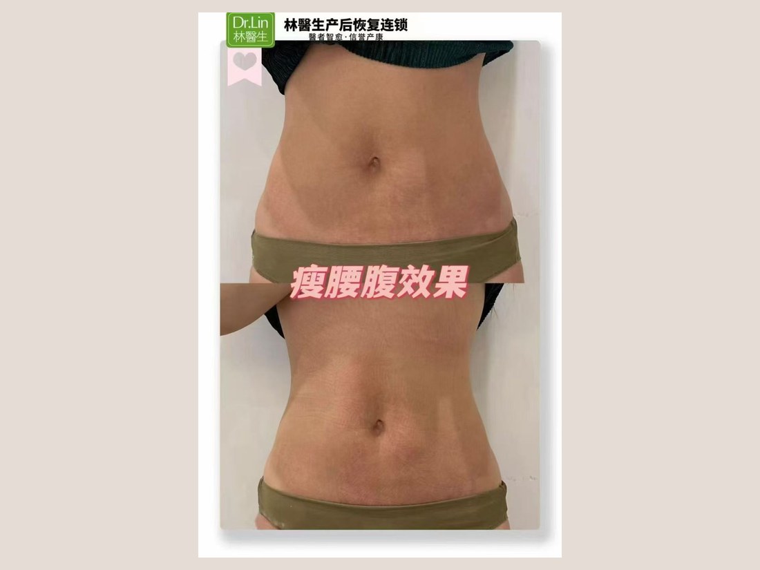 身材管理科部客户案例：瘦腰腹效果