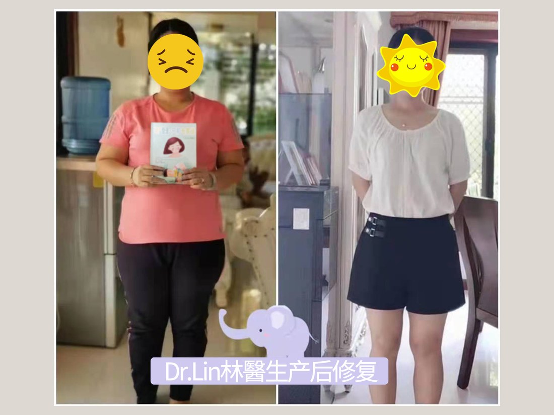 身材管理科部客户案例：产后体型调理前后对照