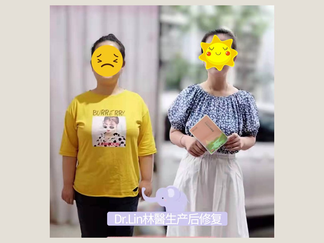 身材管理科部客户案例：产后体型调理前后对照