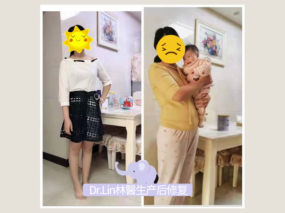 身材管理科部客户案例：产后体型调理前后对照