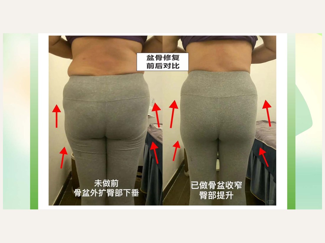 骨龄抗衰科部客户案例：黄金五步骨盆修复