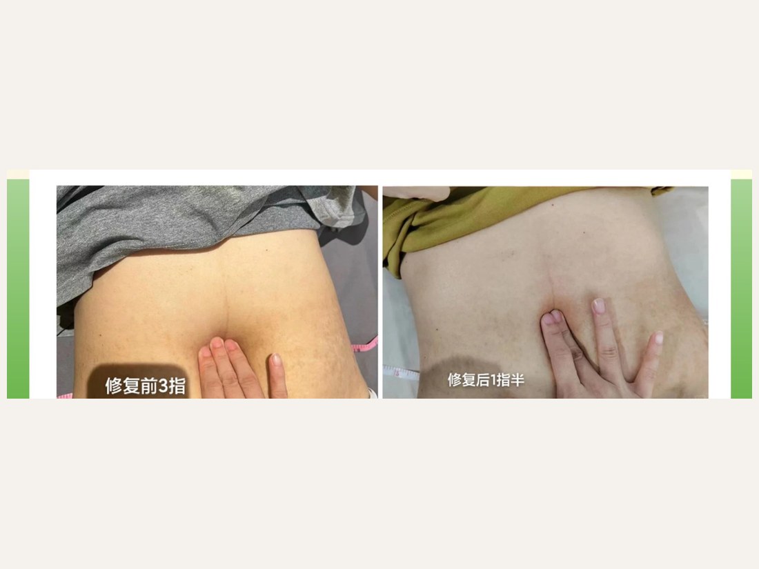身材管理科部客户案例：腹直肌分离修复