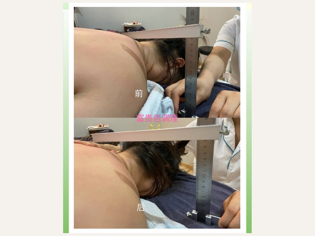 中医调理部客户案例：富贵包调理