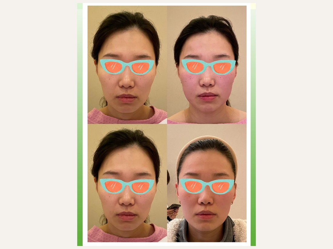 骨龄抗衰科部客户案例：面部骨龄抗衰