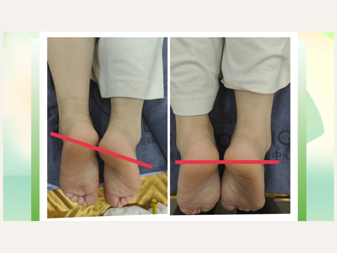 骨龄抗衰科部客户案例：骨盆修复 · 长短腿