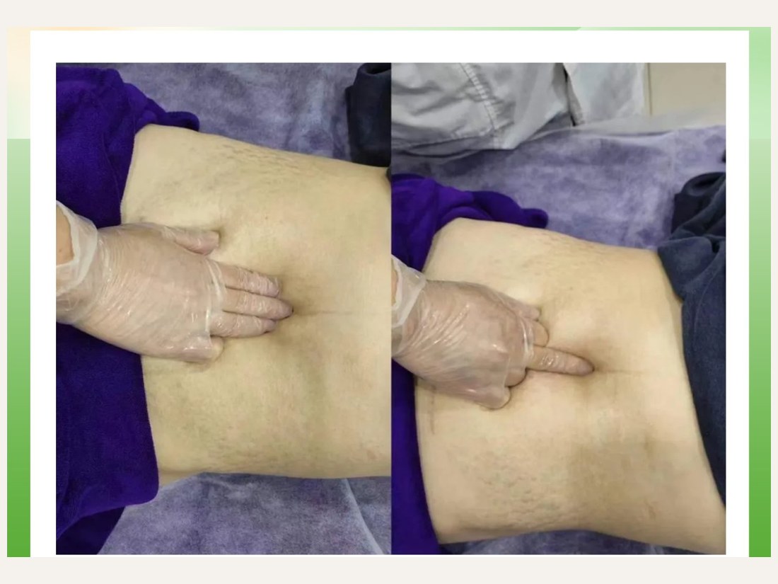 身材管理科部客户案例：腹直肌修复手法记录