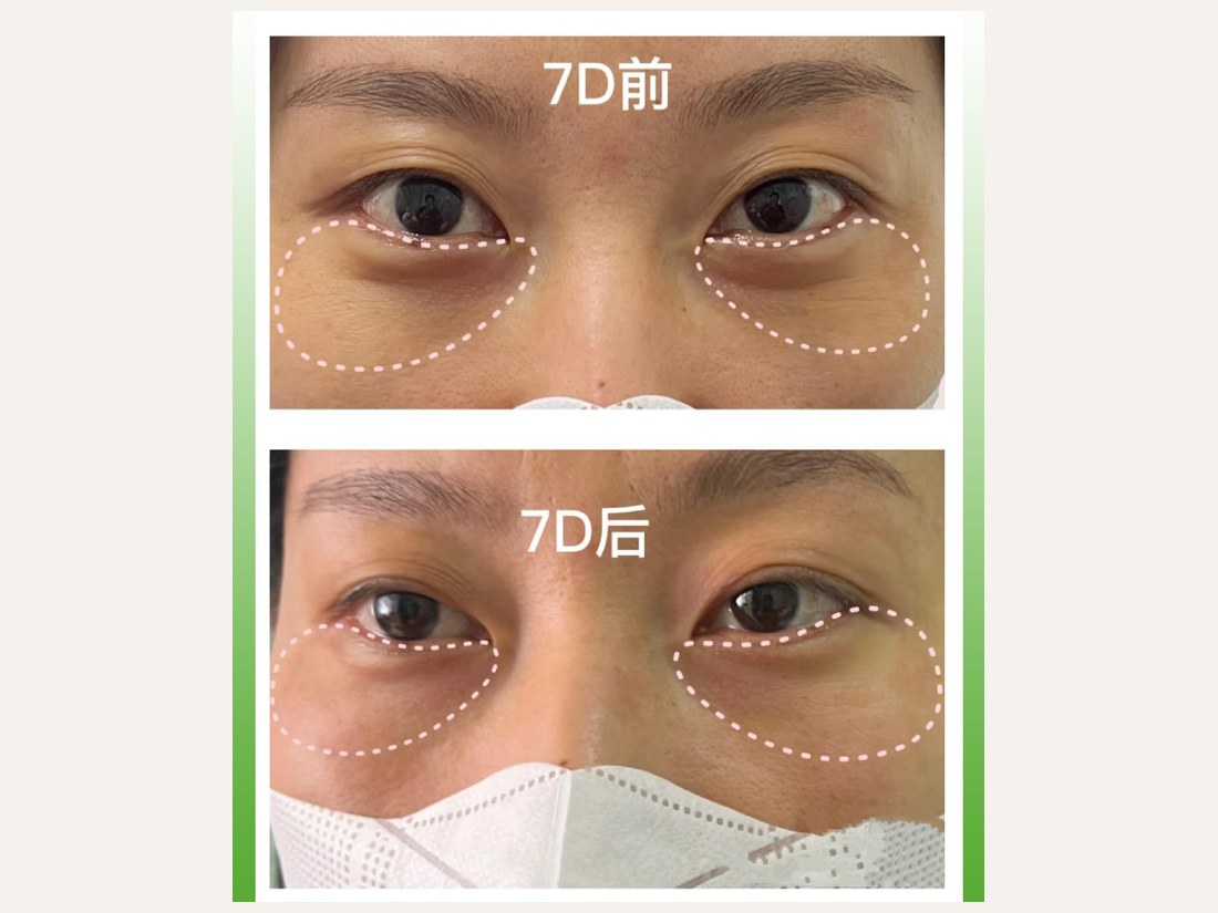 科技美肤部客户案例：7D 聚拉提