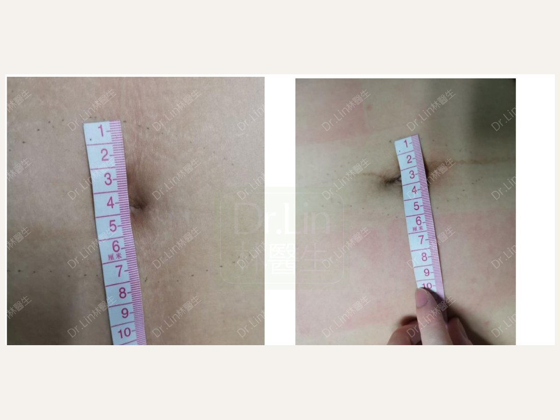 科技美肤部客户案例：妊娠纹 7cm → 5cm