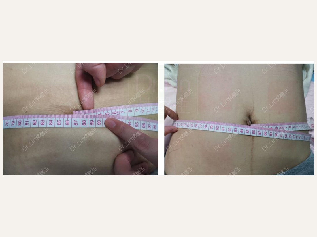 身材管理科部客户案例：腰围 87 → 85cm