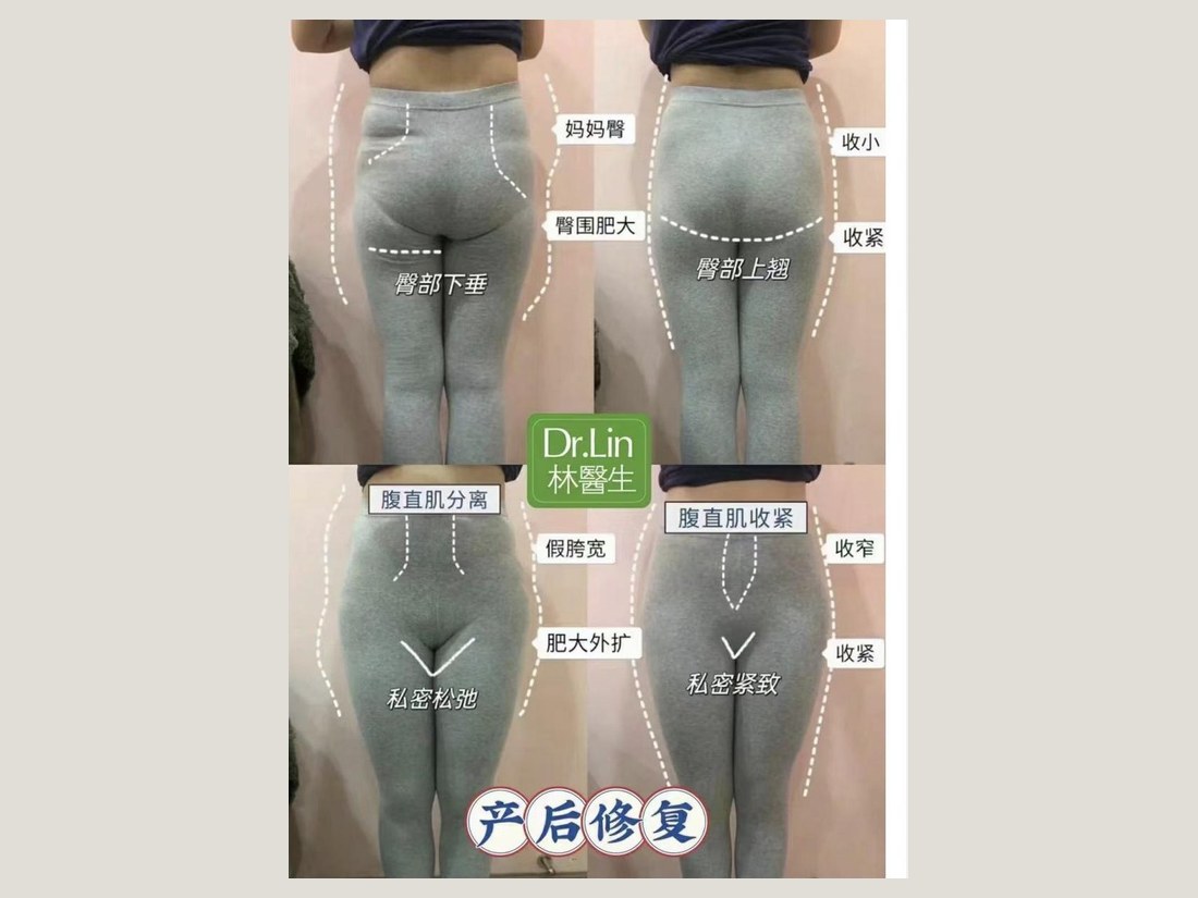 身材管理科部客户案例：产后修复综合对照