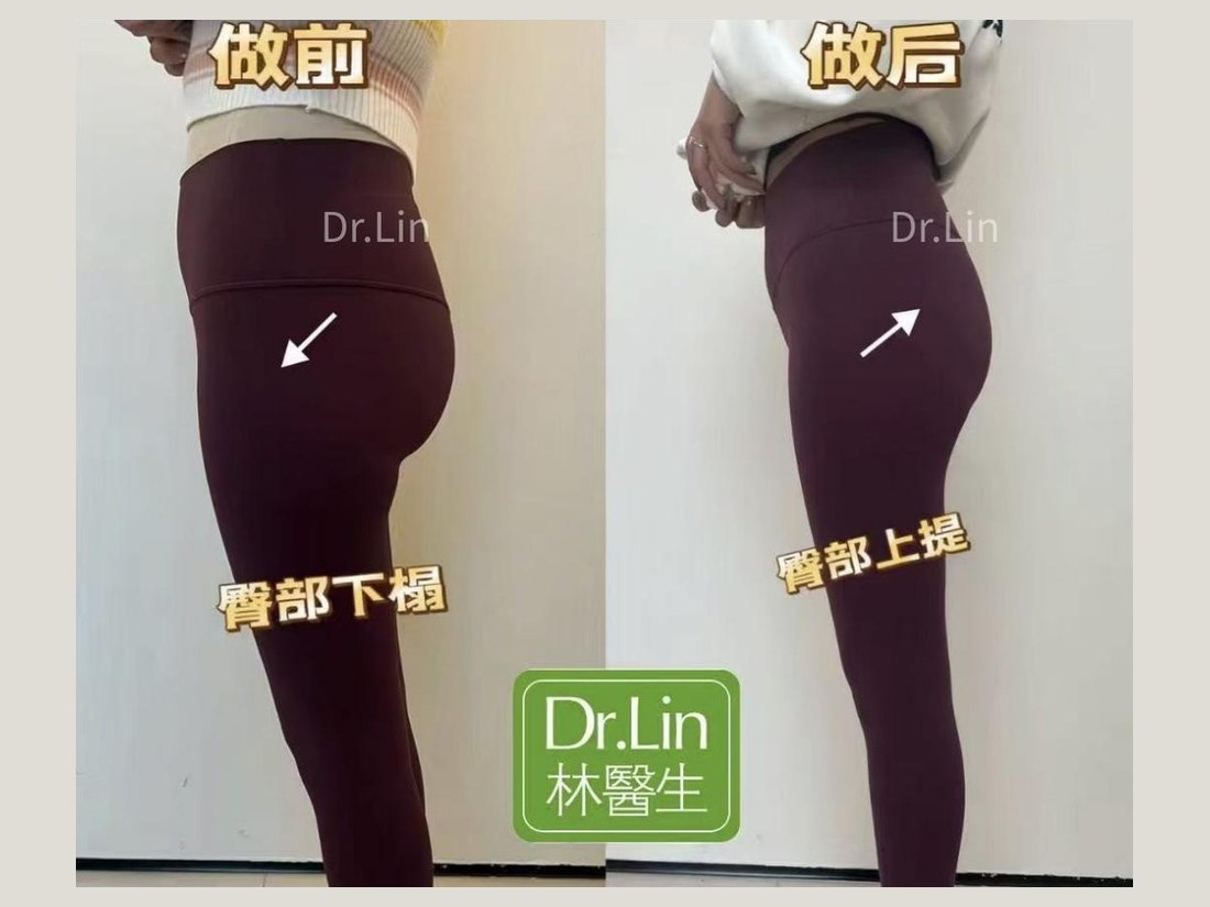 身材管理科部客户案例：臀部上提