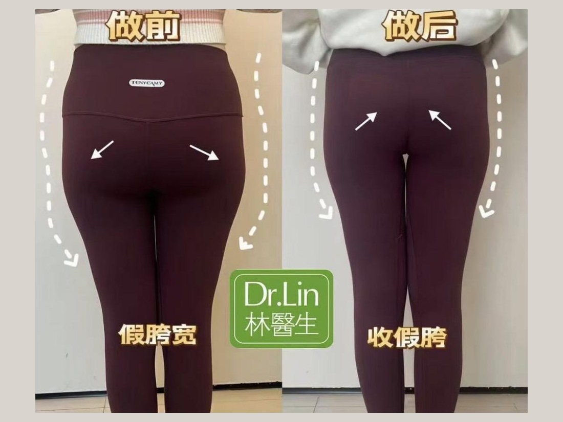身材管理科部客户案例：收假胯