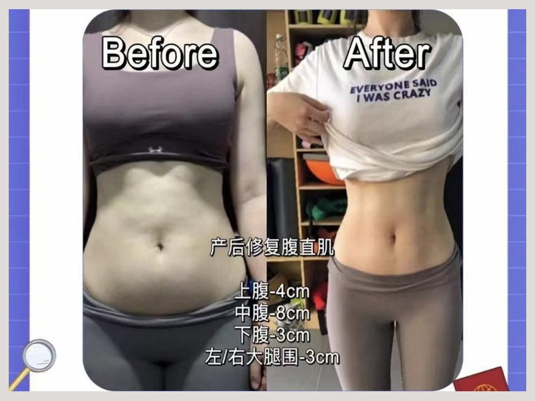 骨龄抗衰科部客户案例：腹直肌修复前后对比