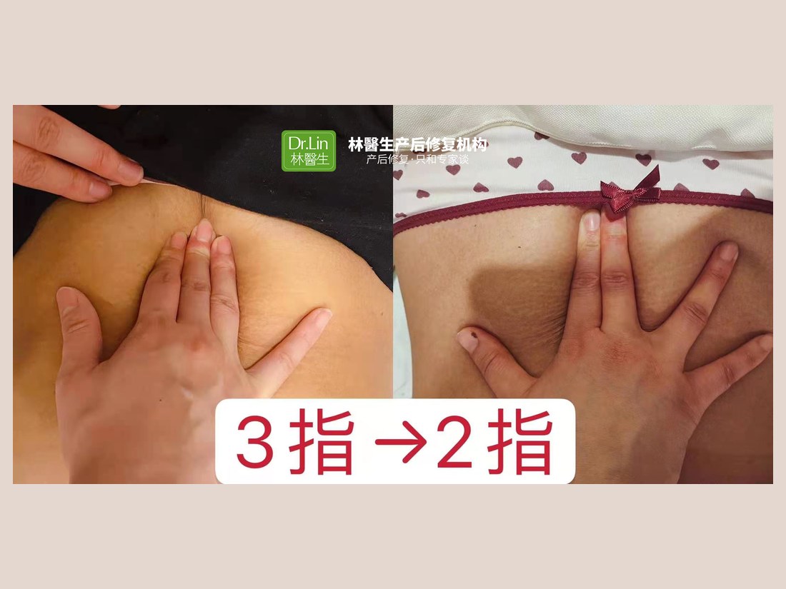 身材管理科部客户案例：腹直肌修复 3 指 → 2 指