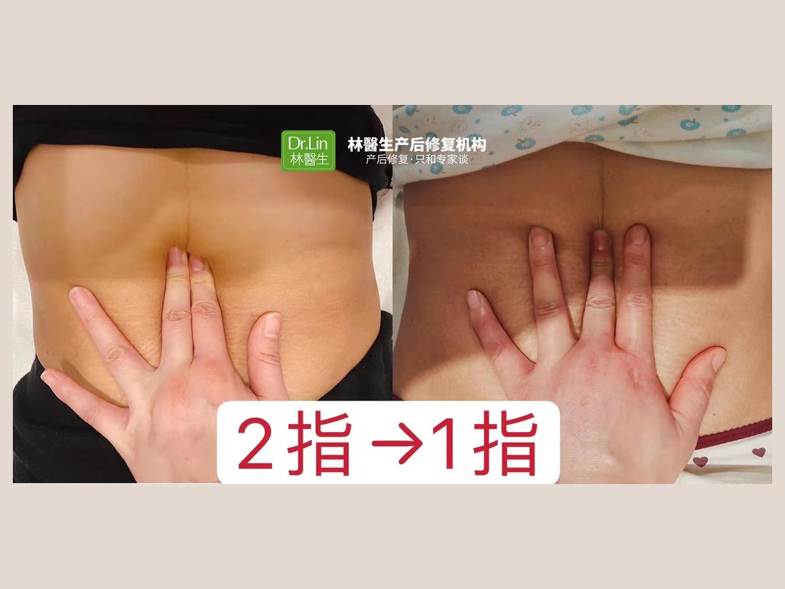 身材管理科部客户案例：腹直肌修复 2 指 → 1 指