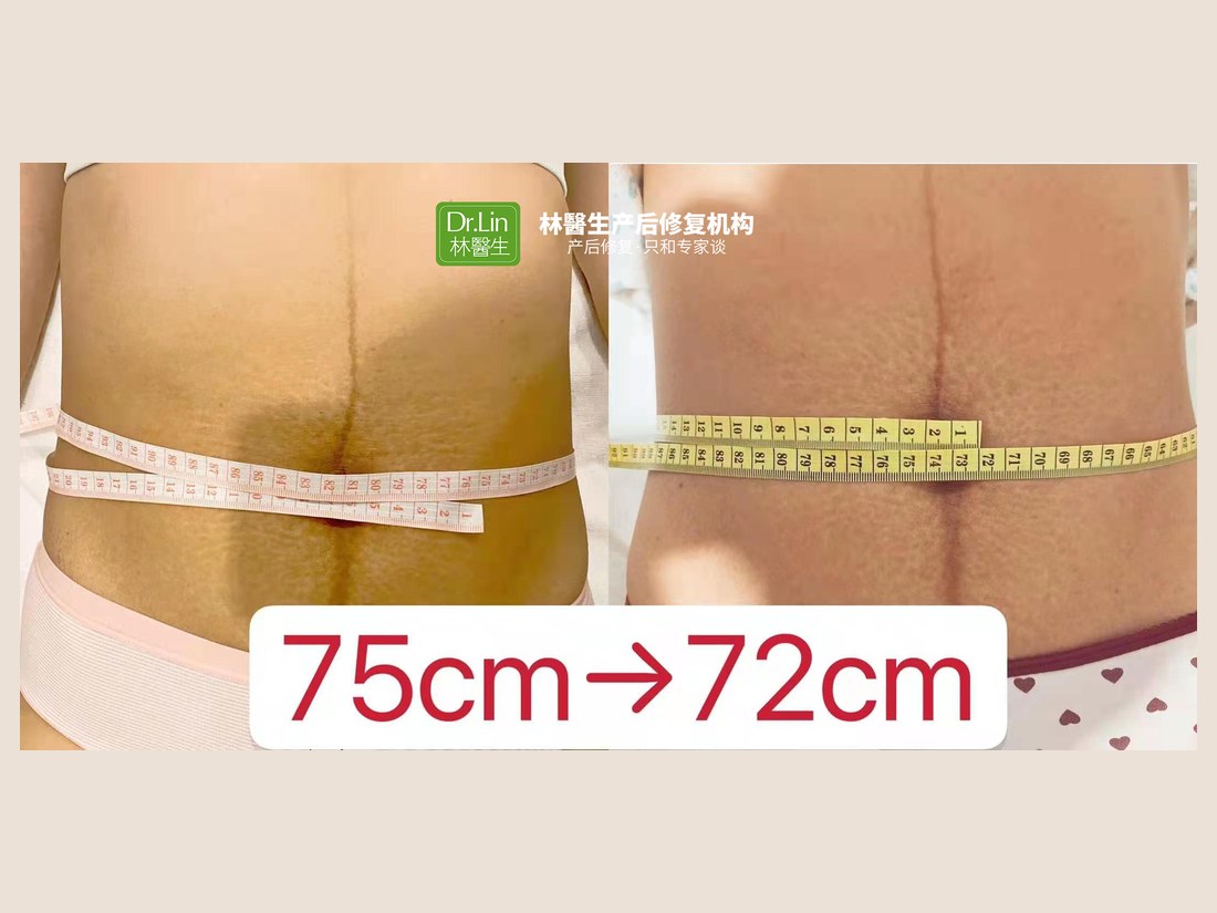 身材管理科部客户案例：腰围 75cm → 72cm
