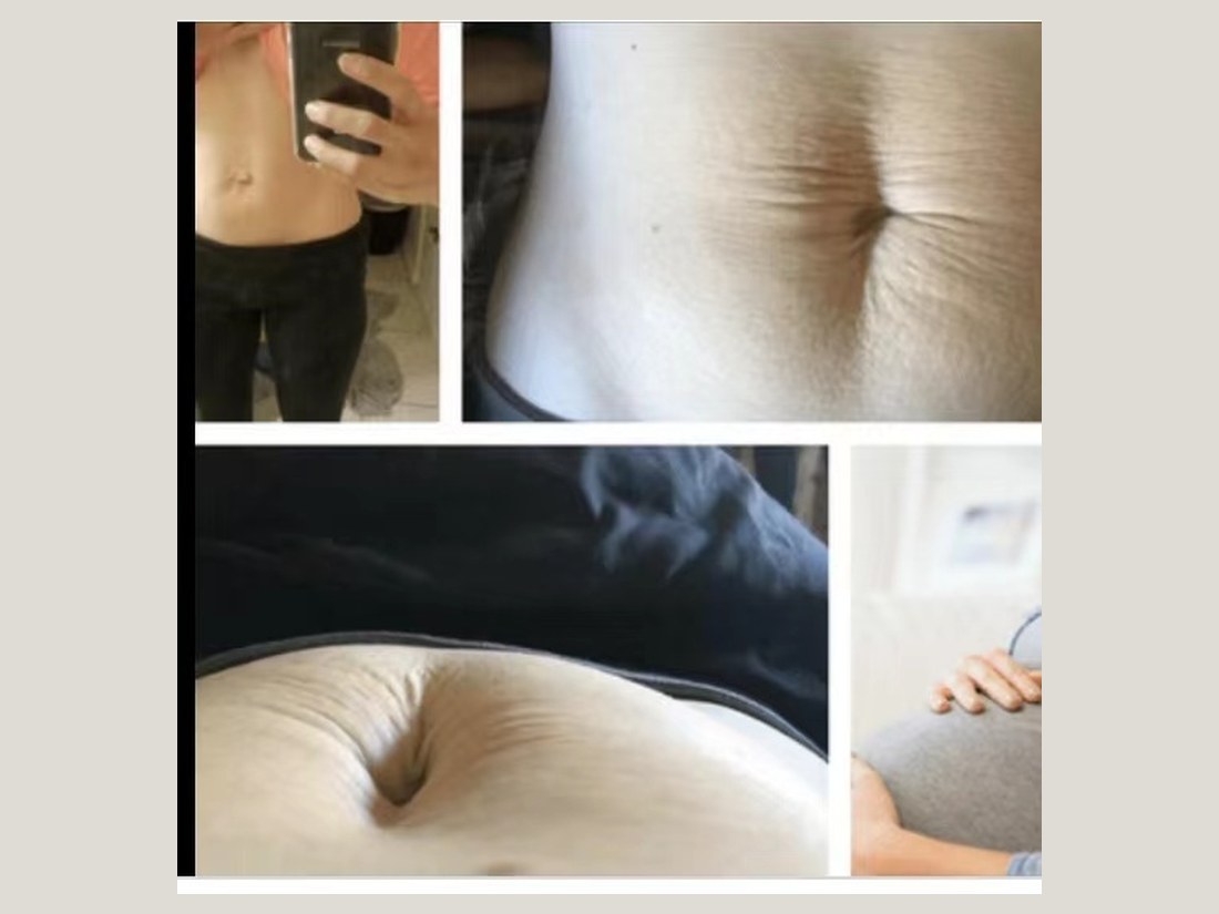 身材管理科部客户案例：腹直肌局部对照