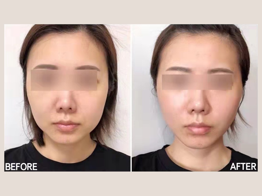 科技美肤部客户案例：面部状态对比