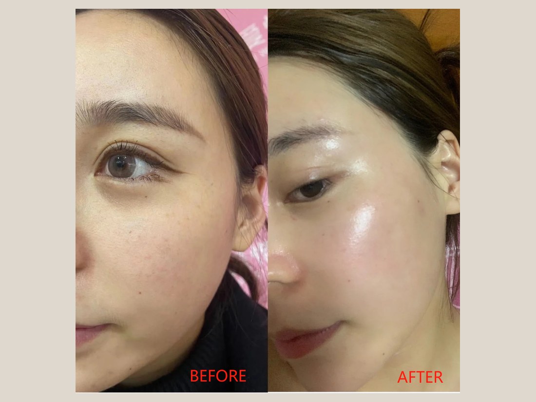 科技美肤部客户案例：眼周状态对比
