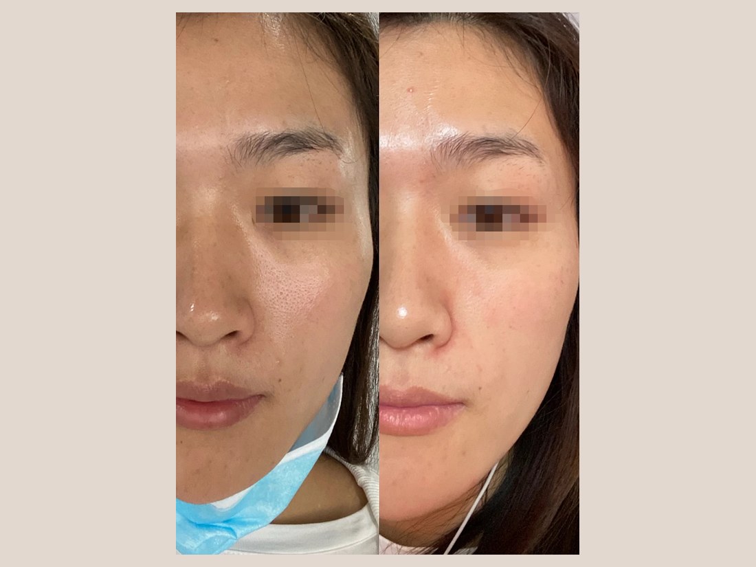 科技美肤部客户案例：眼周状态对比