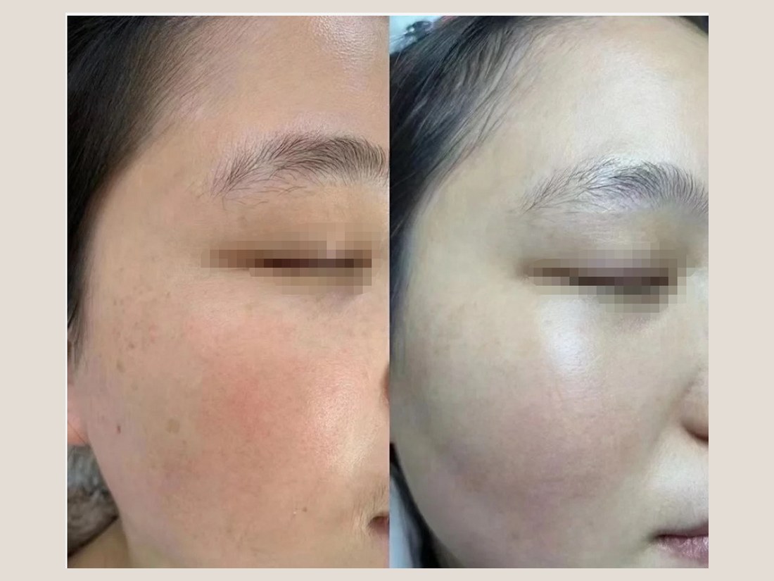 科技美肤部客户案例：眼周细节对照