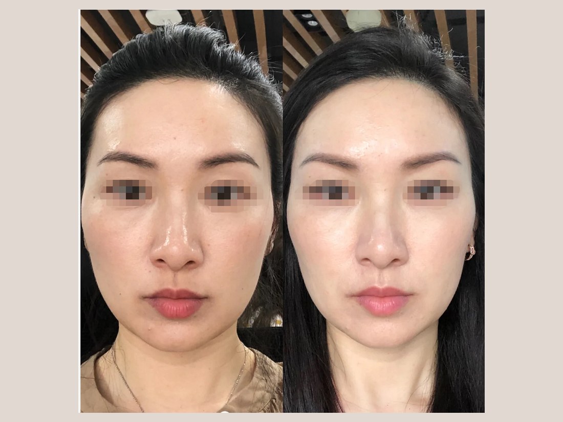 科技美肤部客户案例：面部轮廓对比
